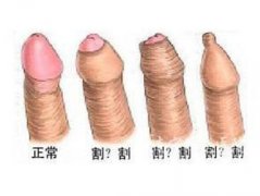 包皮过长会给男性造成哪些危害